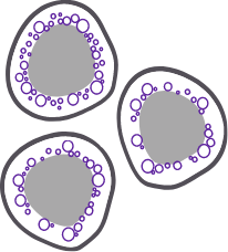 Ring sideroblasts