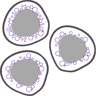 Ring sideroblasts